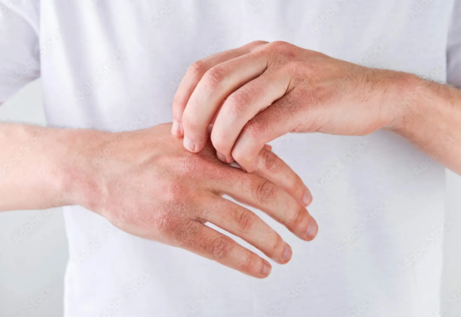 A person in a white shirt is scratching their itchy hand, which shows signs of dryness and redness, potentially benefiting from bioenergy healing to soothe the irritation.